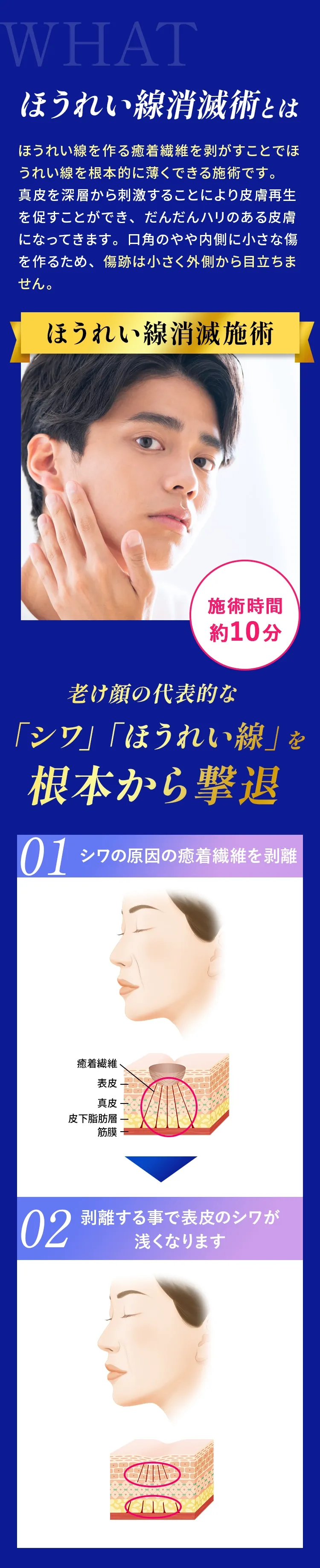 ほうれい線消滅術とは